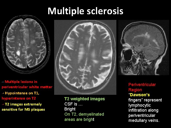 Multiple sclerosis -- Multiple lesions in periventricular white matter -- Hypointense on T 1,