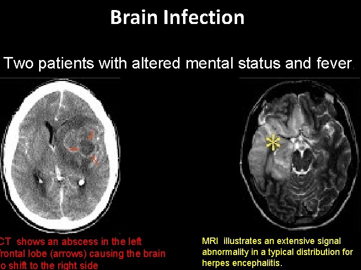 Brain Infection Two patients with altered mental status and fever. CT shows an abscess