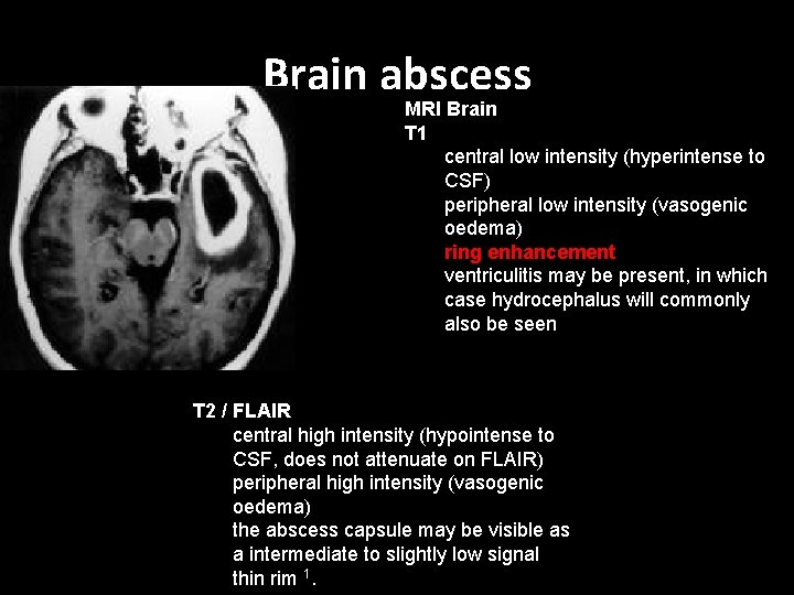 Brain abscess MRI Brain T 1 central low intensity (hyperintense to CSF) peripheral low