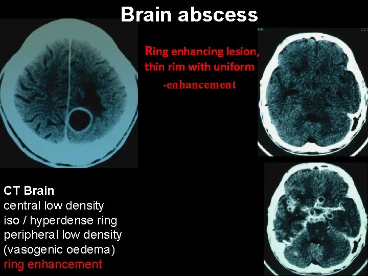 Brain abscess Ring enhancing lesion, thin rim with uniform -enhancement CT Brain central low
