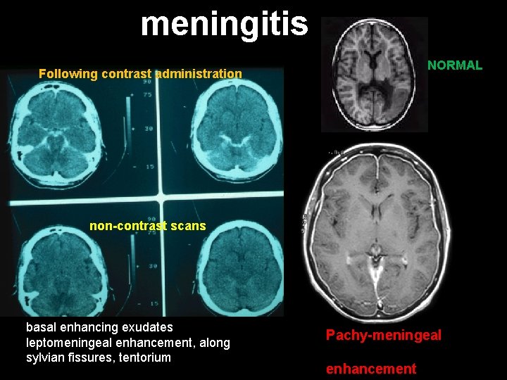 meningitis NORMAL Following contrast administration non-contrast scans basal enhancing exudates leptomeningeal enhancement, along sylvian