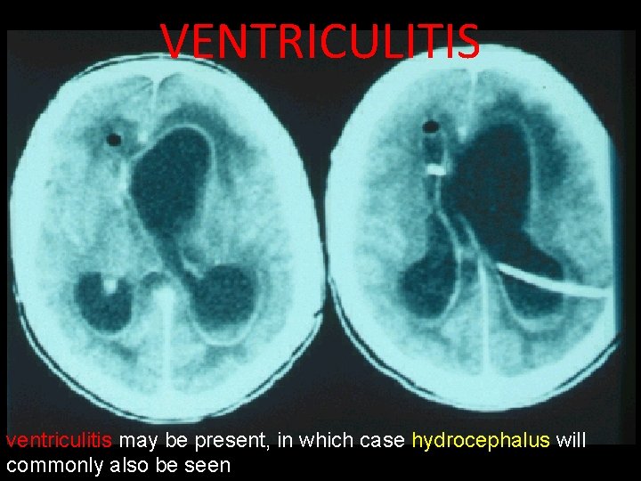 VENTRICULITIS ventriculitis may be present, in which case hydrocephalus will commonly also be seen
