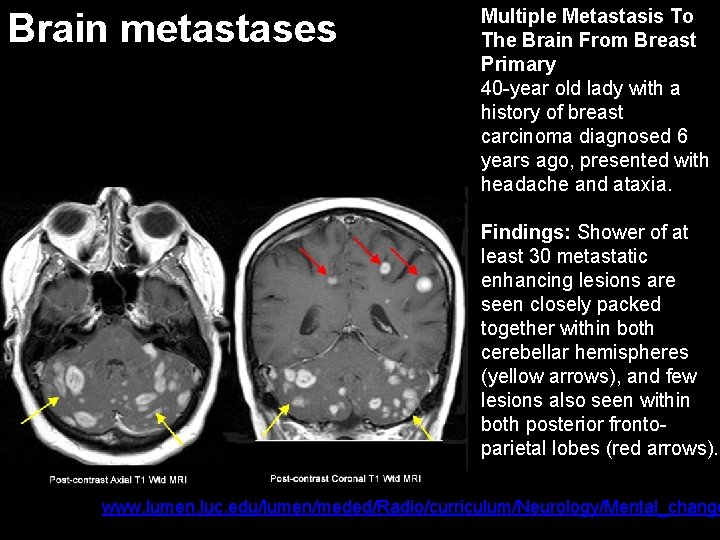 Brain metastases Multiple Metastasis To The Brain From Breast Primary 40 -year old lady