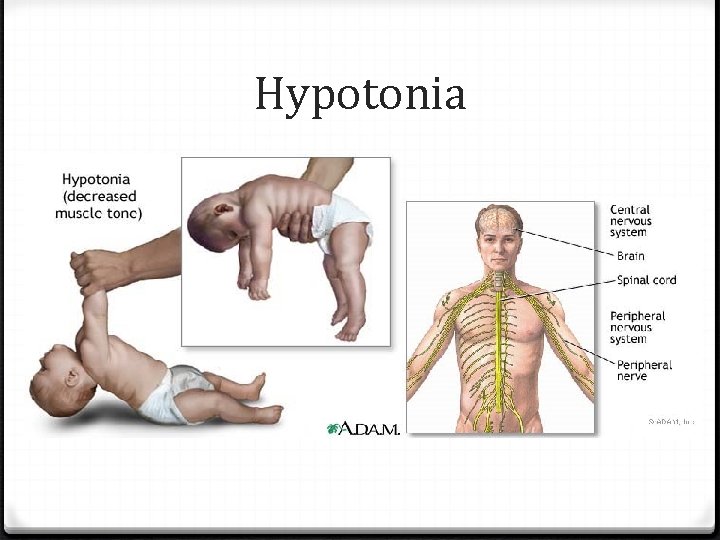 Hypotonia 