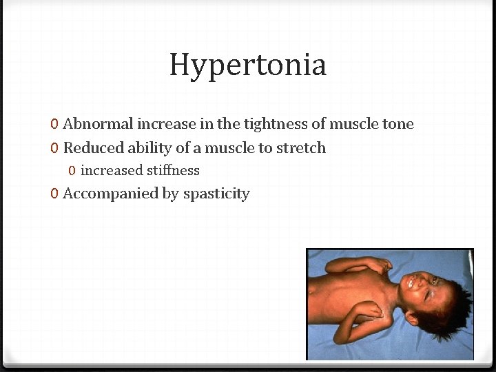Hypertonia 0 Abnormal increase in the tightness of muscle tone 0 Reduced ability of