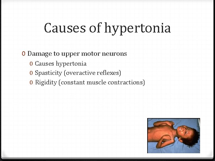 Causes of hypertonia 0 Damage to upper motor neurons 0 Causes hypertonia 0 Spasticity