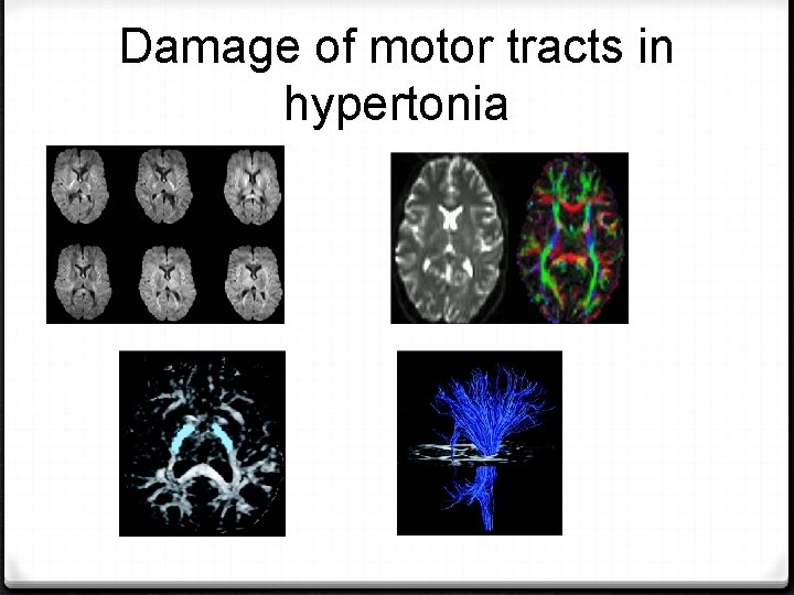 Damage of motor tracts in hypertonia 