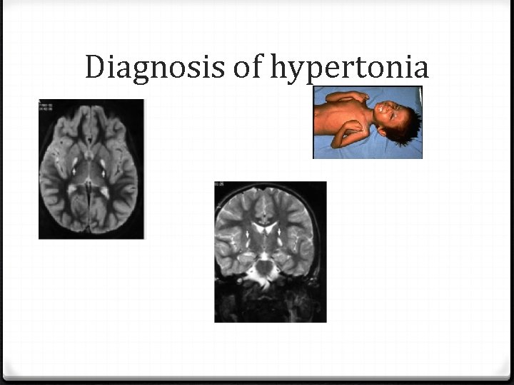 Diagnosis of hypertonia 