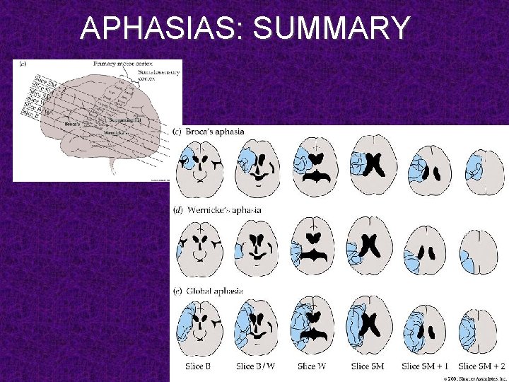 APHASIAS: SUMMARY 