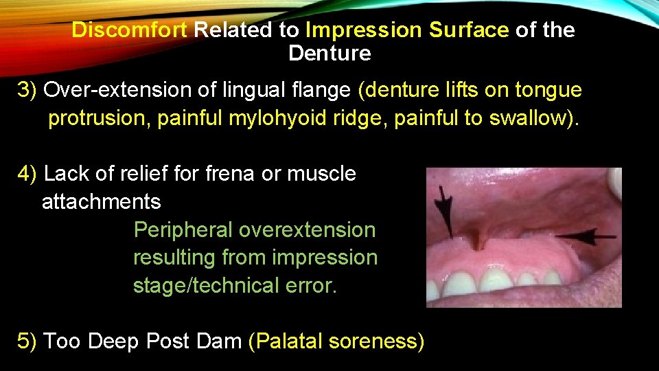 Discomfort Related to Impression Surface of the Denture 3) Over-extension of lingual flange (denture