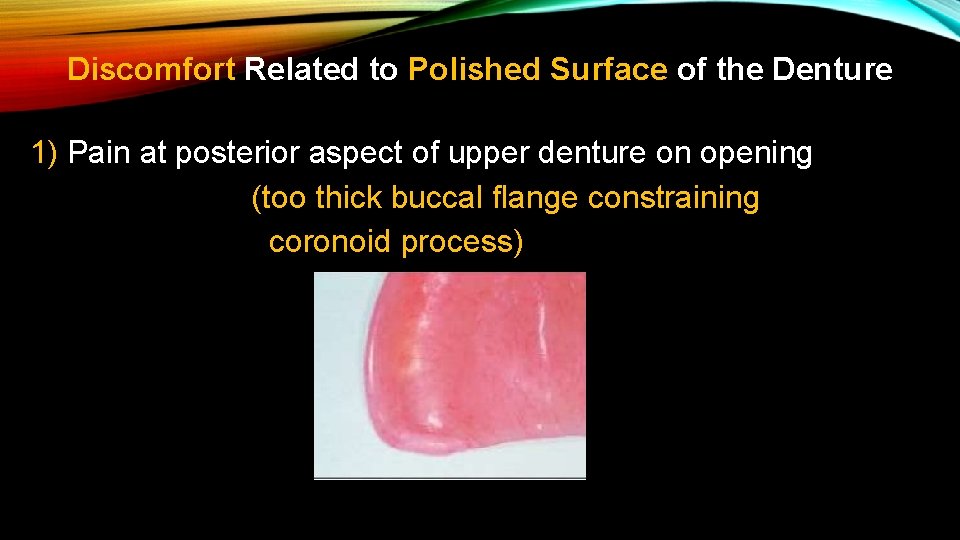 Discomfort Related to Polished Surface of the Denture 1) Pain at posterior aspect of