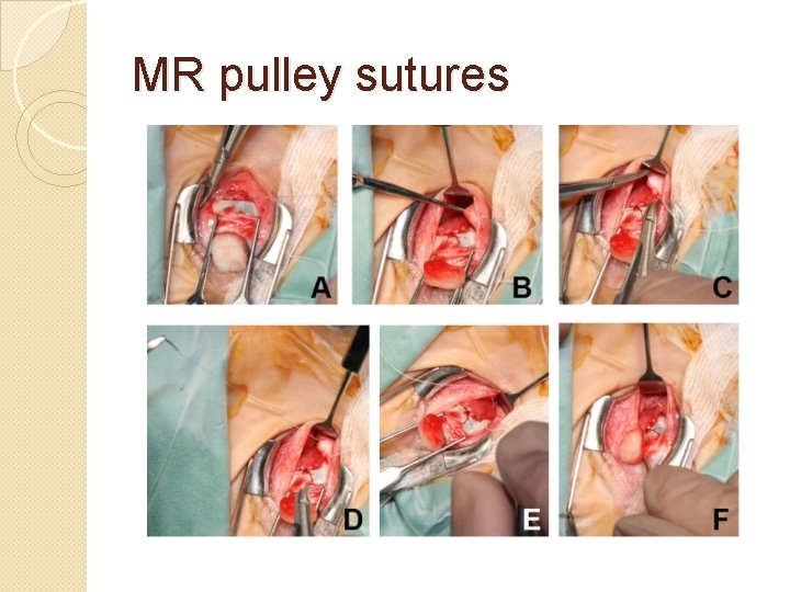 MR pulley sutures 