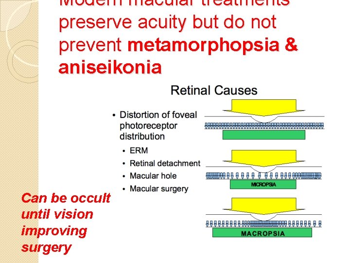 Modern macular treatments preserve acuity but do not prevent metamorphopsia & aniseikonia Can be
