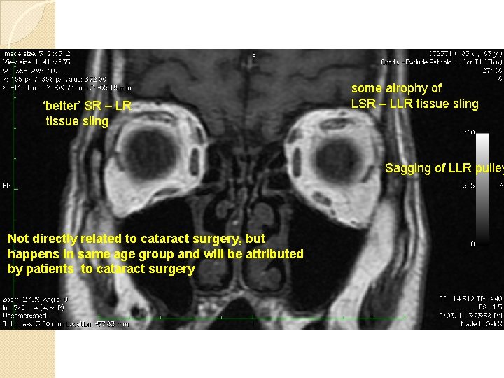 ‘better’ SR – LR tissue sling some atrophy of LSR – LLR tissue sling