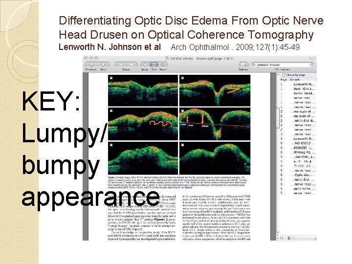 Differentiating Optic Disc Edema From Optic Nerve Head Drusen on Optical Coherence Tomography Lenworth