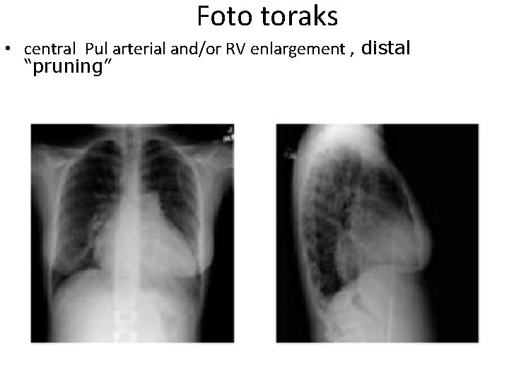 Foto toraks • central Pul arterial and/or RV enlargement , distal “pruning” 