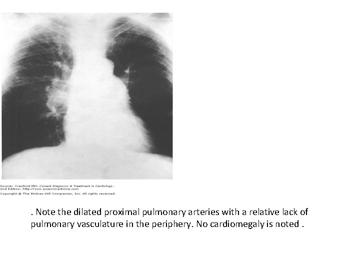 . Note the dilated proximal pulmonary arteries with a relative lack of pulmonary vasculature