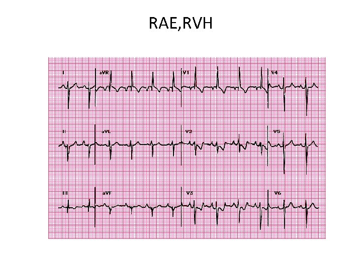 RAE, RVH 