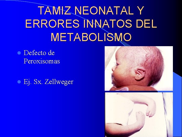 TAMIZ NEONATAL Y ERRORES INNATOS DEL METABOLISMO l Defecto de Peroxisomas l Ej. Sx.