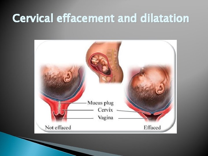 Cervical effacement and dilatation 