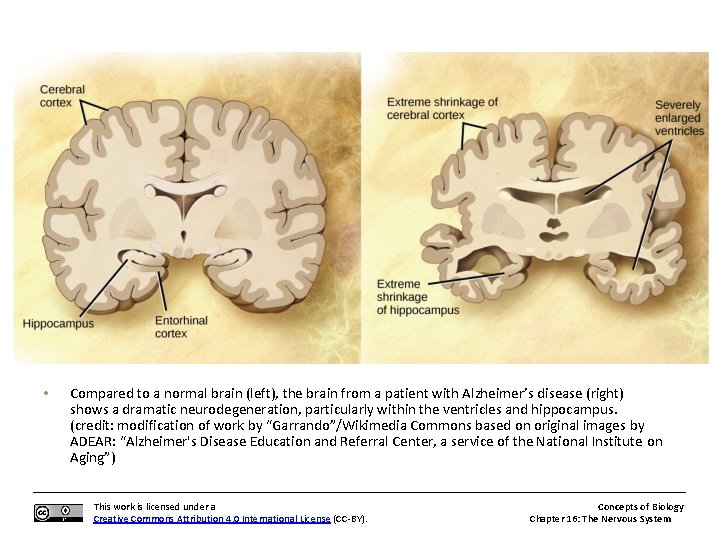  • Compared to a normal brain (left), the brain from a patient with