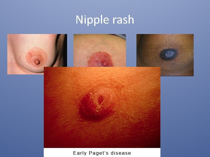 Nipple rash 
