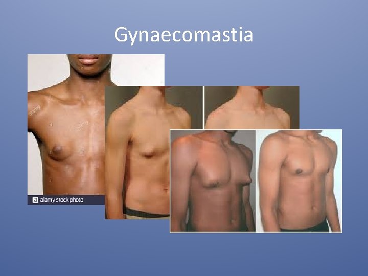 Gynaecomastia 