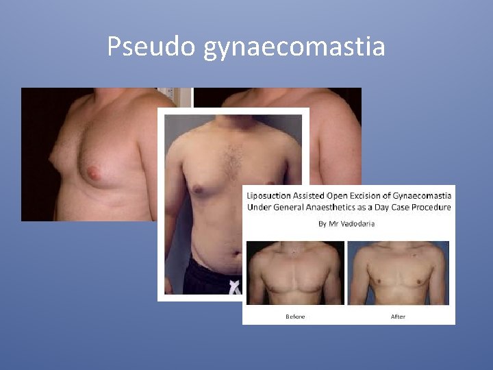 Pseudo gynaecomastia 
