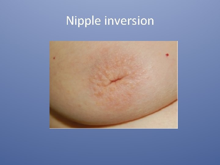 Nipple inversion 