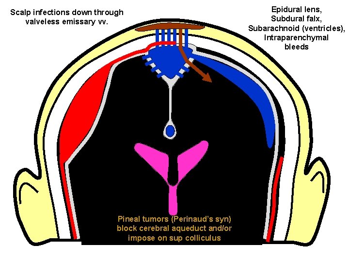 Scalp infections down through valveless emissary vv. Pineal tumors (Perinaud’s syn) block cerebral aqueduct