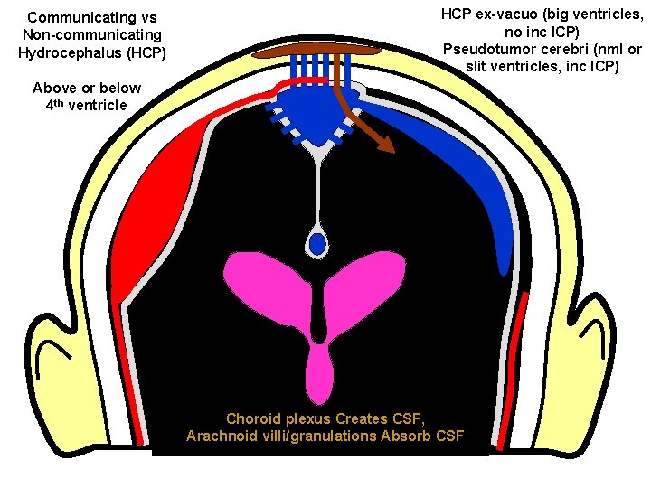 Communicating vs Non-communicating Hydrocephalus (HCP) HCP ex-vacuo (big ventricles, no inc ICP) Pseudotumor cerebri