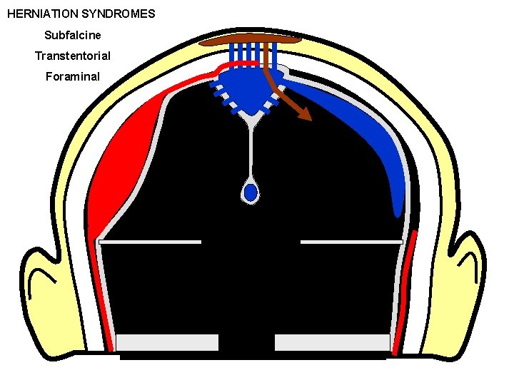 HERNIATION SYNDROMES Subfalcine Transtentorial Foraminal 