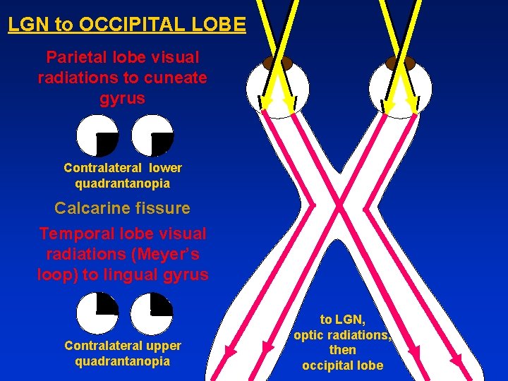 LGN to OCCIPITAL LOBE Parietal lobe visual radiations to cuneate gyrus Contralateral lower quadrantanopia