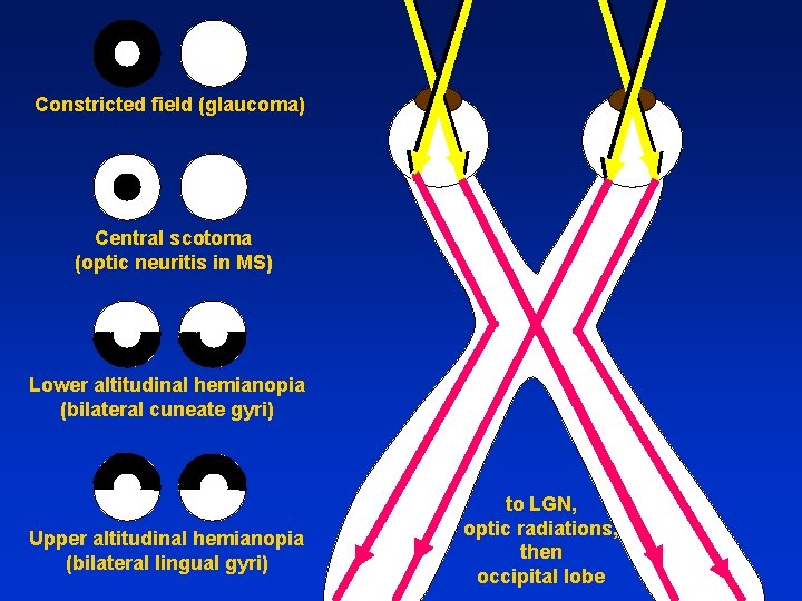 Constricted field (glaucoma) Central scotoma (optic neuritis in MS) Lower altitudinal hemianopia (bilateral cuneate