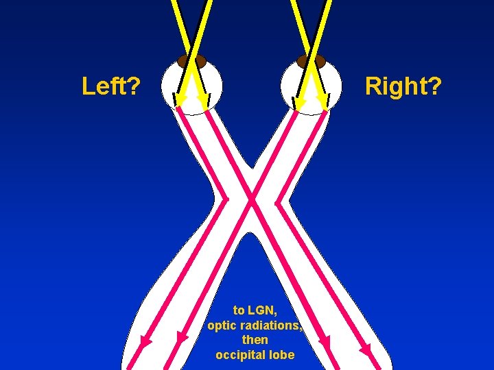 Left? Right? to LGN, optic radiations, then occipital lobe 