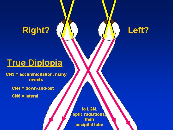 Right? Left? True Diplopia CN 3 = accommodation, many mvmts CN 4 = down-and-out