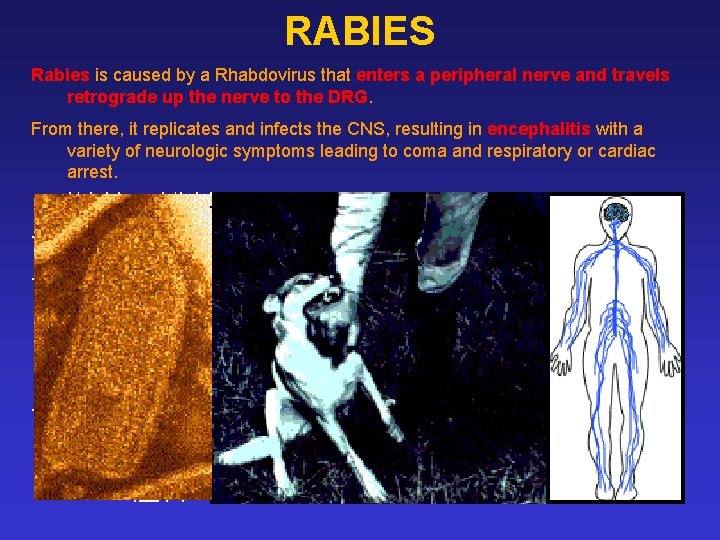 RABIES Rabies is caused by a Rhabdovirus that enters a peripheral nerve and travels