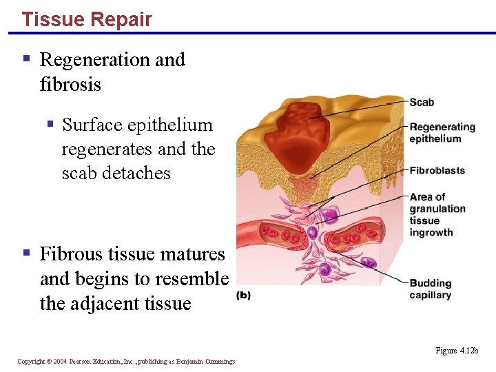 Tissue Repair § Regeneration and fibrosis § Surface epithelium regenerates and the scab detaches