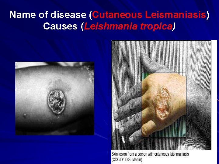 Name of disease (Cutaneous Leismaniasis) Causes (Leishmania tropica) 