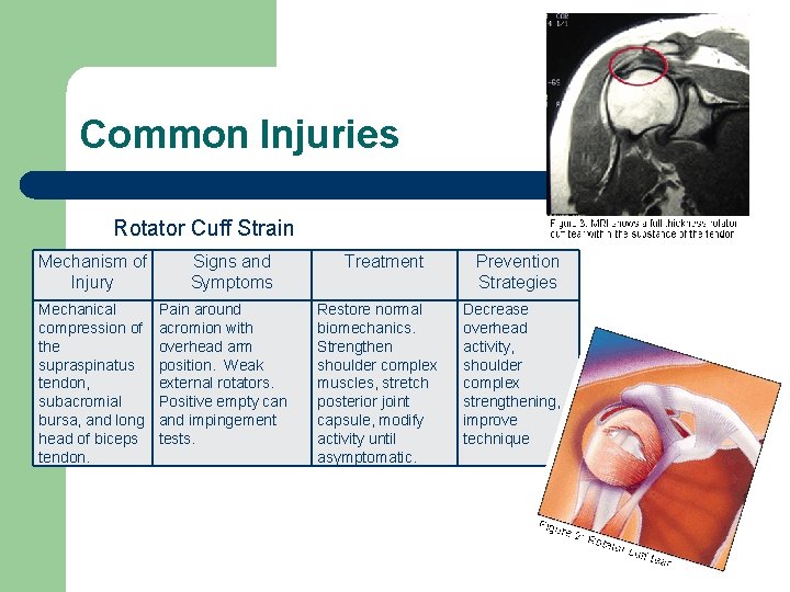 Common Injuries Rotator Cuff Strain Mechanism of Injury Mechanical compression of the supraspinatus tendon,