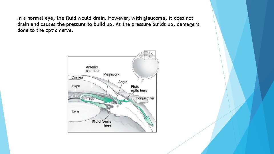 In a normal eye, the fluid would drain. However, with glaucoma, it does not