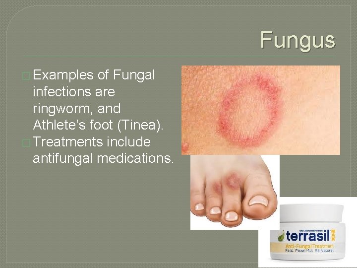 Fungus � Examples of Fungal infections are ringworm, and Athlete’s foot (Tinea). � Treatments
