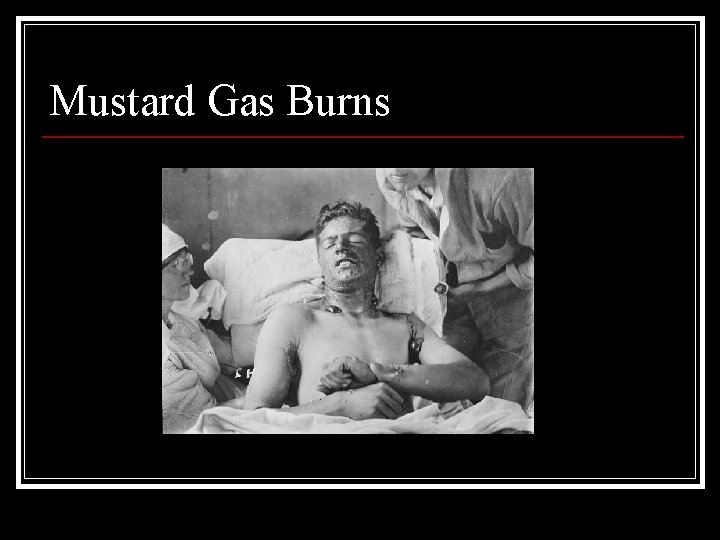 Mustard Gas Burns 