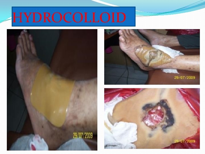 HYDROCOLLOID 