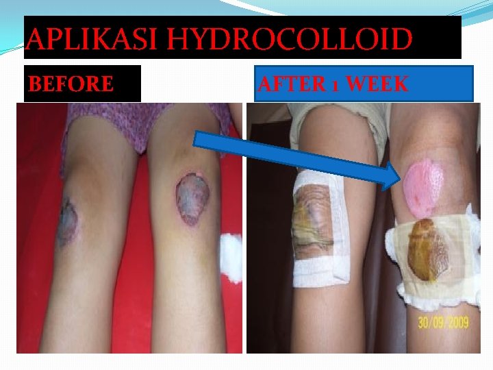 APLIKASI HYDROCOLLOID BEFORE AFTER 1 WEEK 