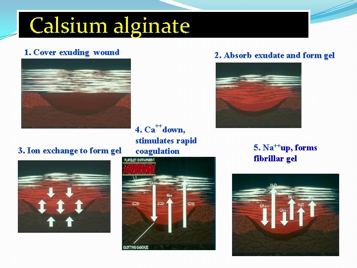 Calsium alginate 1. Cover exuding wound 3. Ion exchange to form gel 2. Absorb