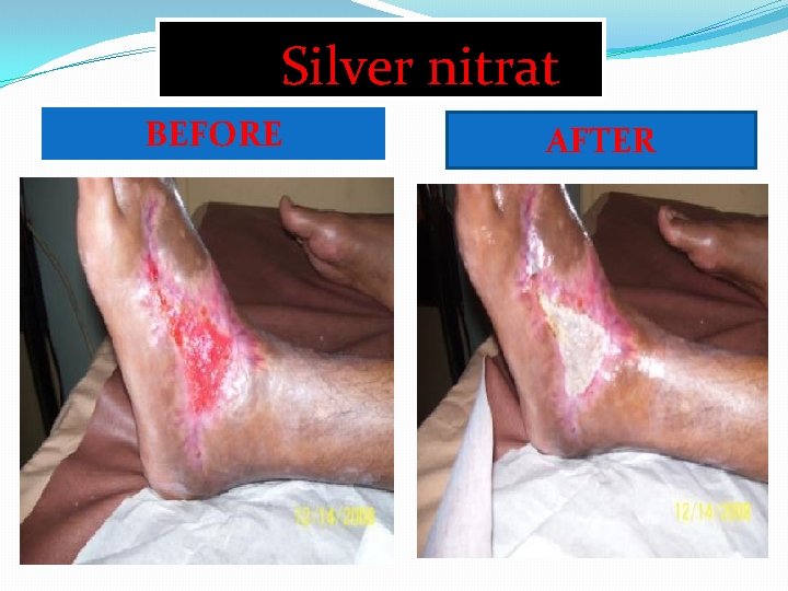 Silver nitrat BEFORE AFTER 