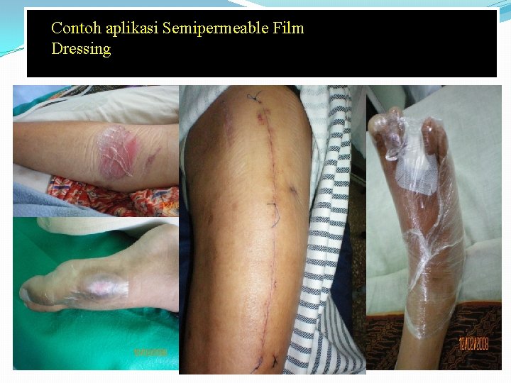 Contoh aplikasi Semipermeable Film Dressing 