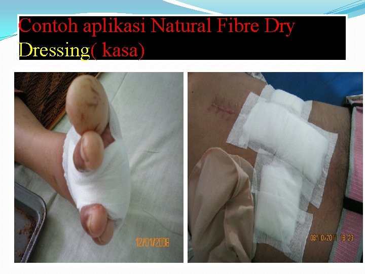 Contoh aplikasi Natural Fibre Dry Dressing( kasa) 