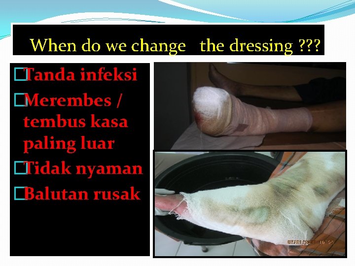 When do we change the dressing ? ? ? �Tanda infeksi �Merembes / tembus